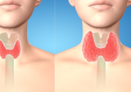 The Impact of Low Iodine on Your Health